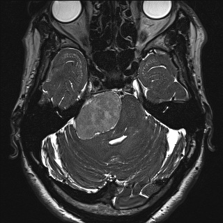 Cerebellopontine angle meningioma (Radiopaedia 72983-83680 Axial FIESTA 39).jpg