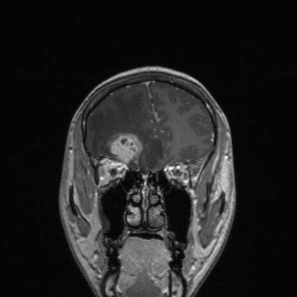 Cerebral abscess (Radiopaedia 24212-24478 Coronal T1 C+ 62).jpg
