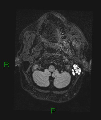 Cerebral abscess and subdural empyema (Radiopaedia 84436-99779 Axial FLAIR 77).jpg