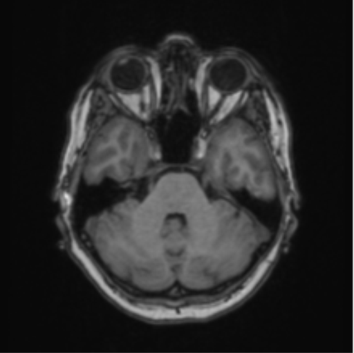 Cerebral abscess from pulmonary arteriovenous malformation (Radiopaedia 86275-102291 Axial T1 23).png