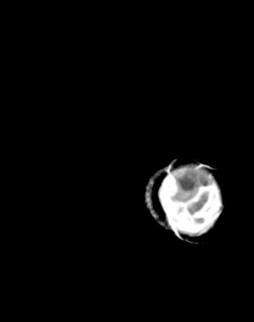 Cerebral abscesses (Radiopaedia 70458-80568 Axial Contrast 60).jpg
