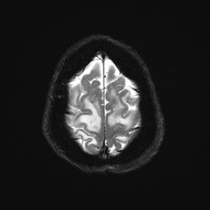 Cerebral amyloid angiopathy-related inflammation (Radiopaedia 74836-85849 Axial DWI 26).jpg