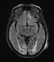 File:Cerebral amyloid angiopathy-related inflammation (Radiopaedia 74836-85849 Axial FLAIR 14).jpg