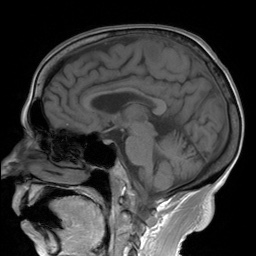 File:Cerebral amyloid angiopathy-related inflammation (Radiopaedia 74836-85849 Sagittal T1 19).jpg