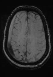 File:Cerebral amyloid angiopathy (Radiopaedia 29129-29518 Axial SWI Magnitude 27).jpg
