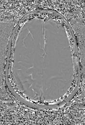 File:Cerebral amyloid angiopathy (Radiopaedia 29129-29518 Axial SWI Phase 28).jpg