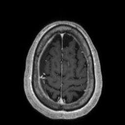 Cerebral amyloid angiopathy (Radiopaedia 29129-29518 Axial T1 C+ 128).jpg