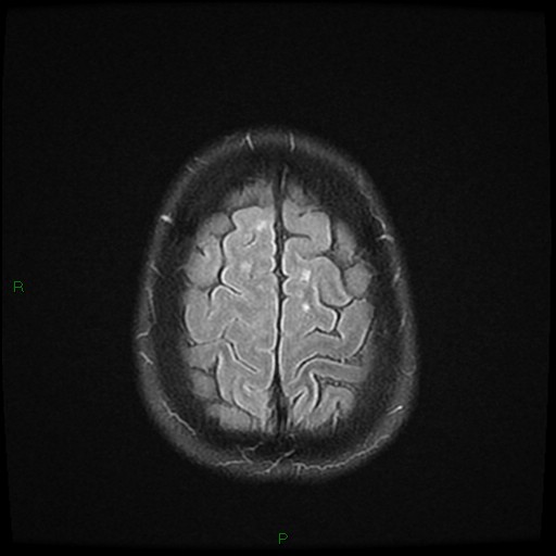 File:Cerebral amyloid angiopathy (Radiopaedia 77506-89664 Axial FLAIR 25).jpg