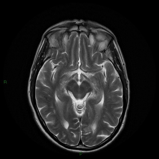 File:Cerebral amyloid angiopathy (Radiopaedia 77506-89664 Axial T2 13).jpg