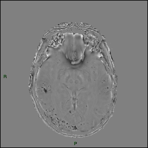 Cerebral amyloid angiopathy (Radiopaedia 77506-89664 H 48).jpg