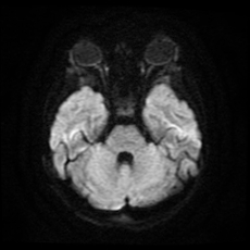 File:Cerebral and spinal tuberculosis (Radiopaedia 90489-107837 Axial DWI 8).jpg