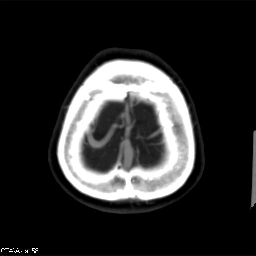 File:Cerebral arteriovenous malformation (Radiopaedia 28518-28759 B 58).jpg