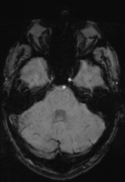 File:Cerebral arteriovenous malformation (Radiopaedia 55798-62372 Axial SWI 10).png