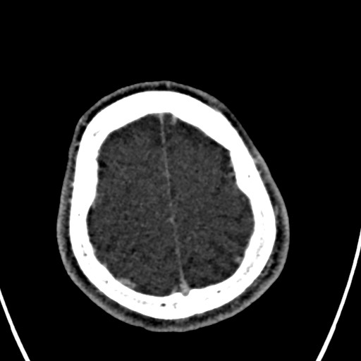 Cerebral arteriovenous malformation (Radiopaedia 78188-90746 Axial C+ delayed 148).jpg