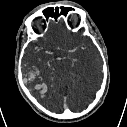 Cerebral arteriovenous malformation (Radiopaedia 78188-90746 Axial C+ delayed 69).jpg