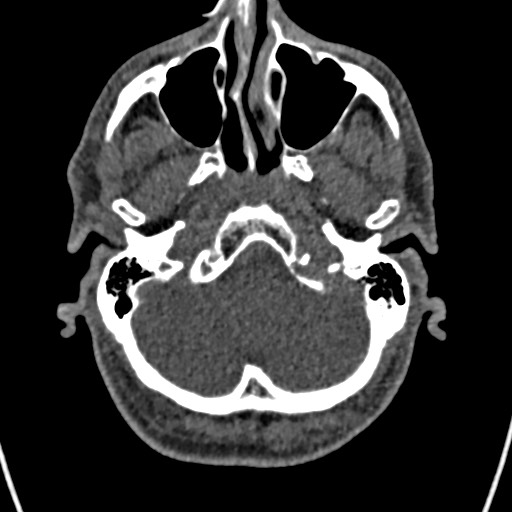 Cerebral arteriovenous malformation (Radiopaedia 78188-90746 Axial non-contrast 27).jpg