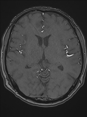 Cerebral arteriovenous malformation (Radiopaedia 84015-99245 Axial TOF 129).jpg