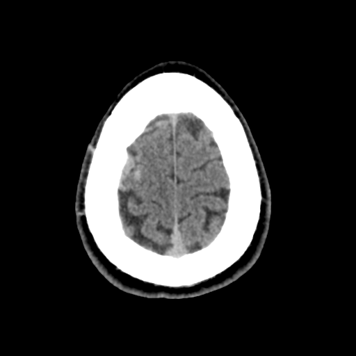 Cerebral arteriovenous malformation (Spetzler-Martin grade 2) (Radiopaedia 41262-44076 Axial non-contrast 49).png