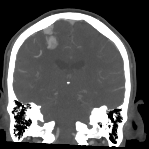 Cerebral arteriovenous malformation (Spetzler-Martin grade 2) (Radiopaedia 41262-44076 F 38).png