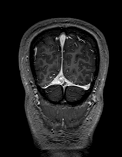 Cerebral arteriovenous malformation at posterior body of corpus callosum (Radiopaedia 74111-84925 K 340).jpg