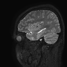 Cerebral arteriovenous malformation at posterior body of corpus callosum (Radiopaedia 74111-84925 Sagittal T2 27).jpg