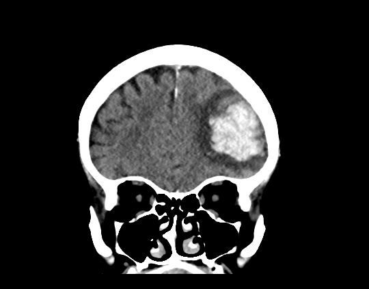 Cerebral arteriovenous malformation with lobar hemorrhage (Radiopaedia 44725-48510 Coronal non-contrast 15).png