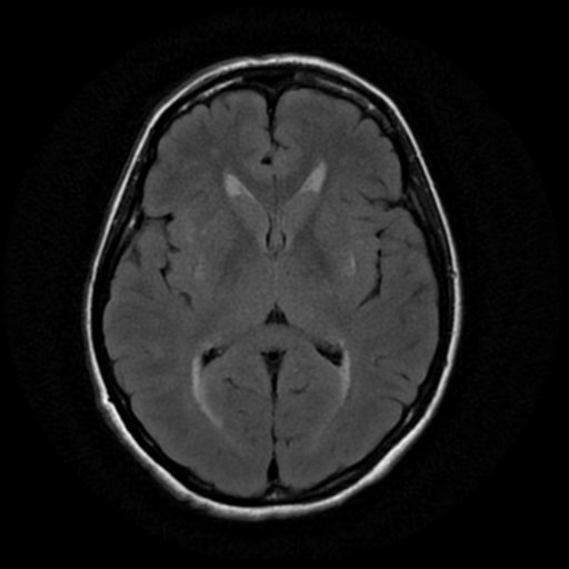 File:Cerebral autosomal dominant arteriopathy with subcortical infarcts and leukoencephalopathy (CADASIL) (Radiopaedia 41018-43763 Ax T2 Flair PROP 11).png