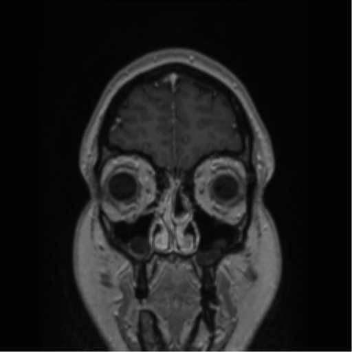 Cerebral cavernoma and development venous anomaly (Radiopaedia 37603-39482 Coronal T1 C+ 81).png
