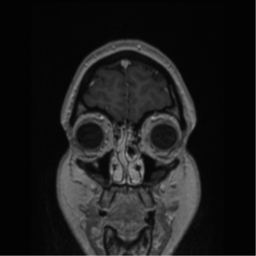 Cerebral cavernoma and development venous anomaly (Radiopaedia 37603-39482 Coronal T1 C+ 83).png