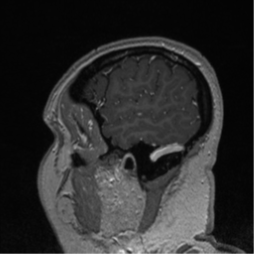 Cerebral cavernoma and development venous anomaly (Radiopaedia 37603-39482 Sagittal T1 C+ 81).png