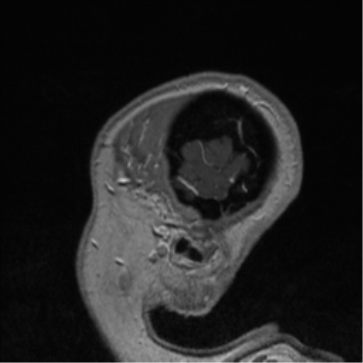 Cerebral cavernoma and development venous anomaly (Radiopaedia 37603-39482 Sagittal T1 C+ 87).png