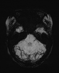 Cerebral cavernous venous malformation (Radiopaedia 70008-80021 Axial SWI 17).jpg