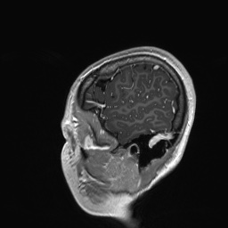 Cerebral cavernous venous malformation (Radiopaedia 70008-80021 Sagittal T1 C+ 9).jpg