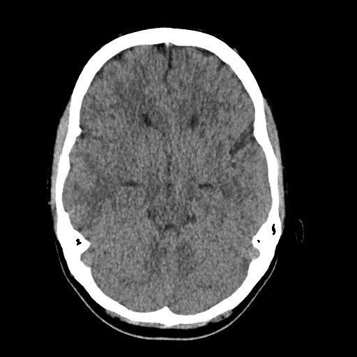 Cerebral cavernous venous malformation (Radiopaedia 70008-80022 Axial non-contrast 18).jpg