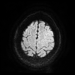 Cerebral cavernous venous malformation (Zabramski type II) (Radiopaedia 85511-101198 Axial DWI 59).jpg