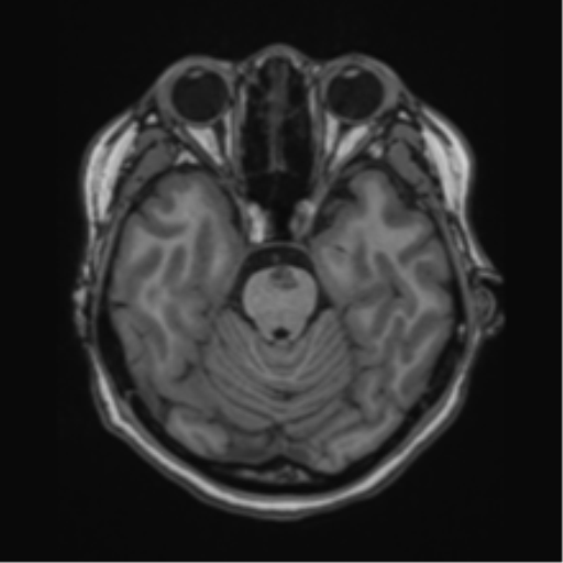 File:Cerebral cavernous venous malformations (Radiopaedia 48117-52946 Axial T1 6).png