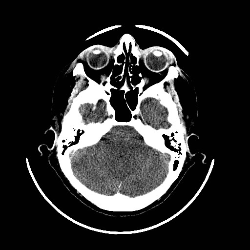 File:Cerebral edema (evolution in time) (Radiopaedia 19418-19439 non-contrast 27).jpg