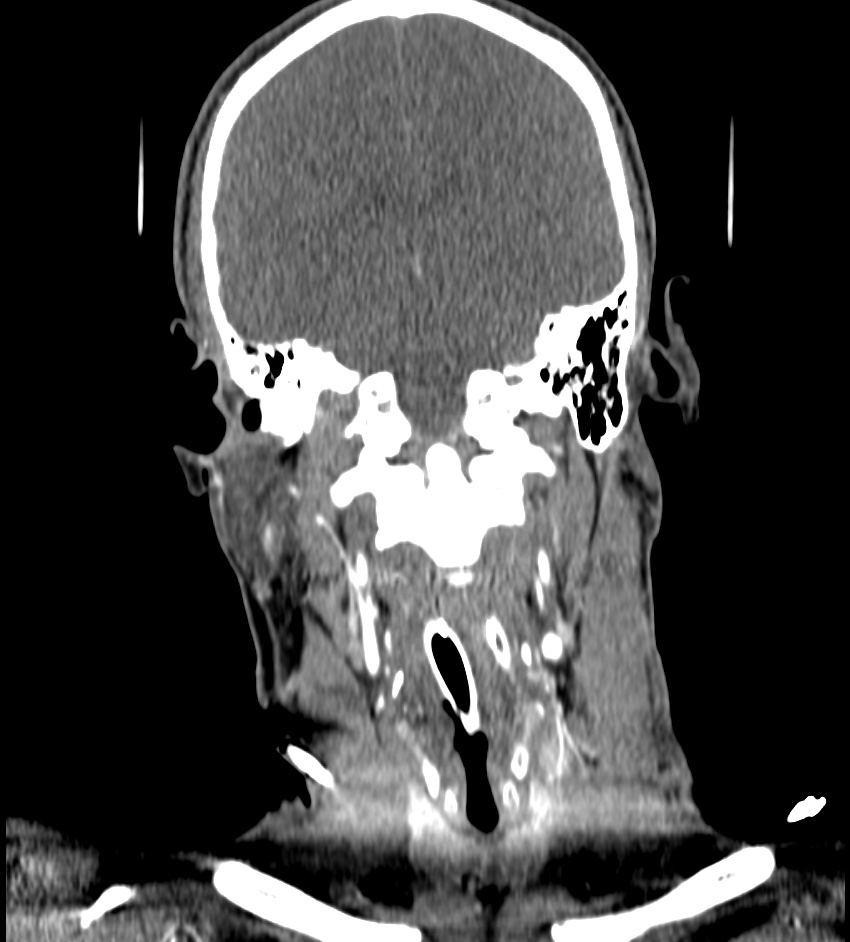 Cerebral edema in an overdose patient (Radiopaedia 72005-82539 B 79).jpg