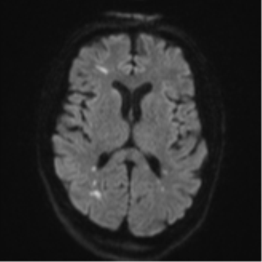 Cerebral embolic infarcts (embolic shower) (Radiopaedia 57395-64342 Axial DWI 56).png