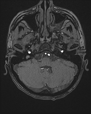 File:Cerebral embolic infarcts (embolic shower) (Radiopaedia 72391-82921 Axial MRA 15).jpg