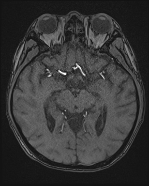Cerebral embolic infarcts (embolic shower) (Radiopaedia 72391-82921 Axial MRA 72).jpg