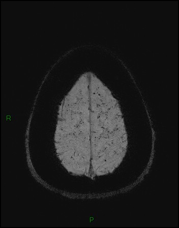 Cerebral fat embolism (Radiopaedia 35022-36525 Axial SWI 57).jpg