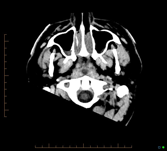 Cerebral fat embolism (Radiopaedia 85521-101224 Axial non-contrast 1).jpg