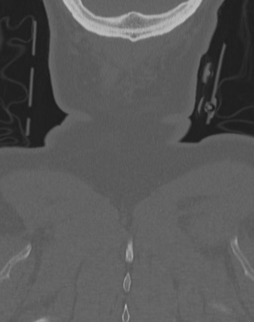 Cerebral hemorrhagic contusions and cervical spine fractures (Radiopaedia 32865-33841 Coronal bone window 79).jpg