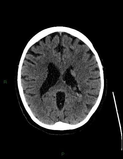 Cerebral metastases - ependymal and parenchymal (Radiopaedia 79877-93131 Axial non-contrast 46).jpg
