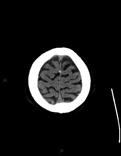 Cerebral metastases - ependymal and parenchymal (Radiopaedia 79877-93131 Axial non-contrast 73).jpg