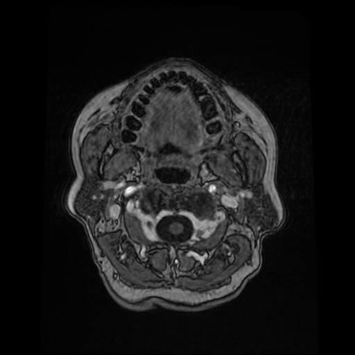 Cerebral metastases - melanoma (Radiopaedia 80972-94522 Axial T1 C+ 14).jpg