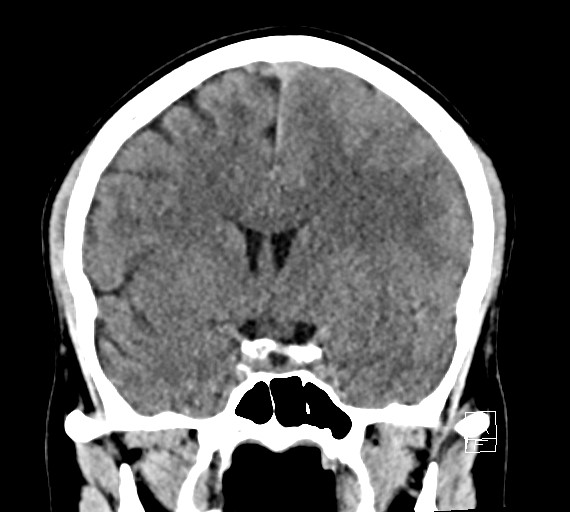 Cerebral metastases - testicular choriocarcinoma (Radiopaedia 84486-99855 Coronal C+ delayed 28).jpg