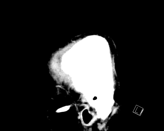 Cerebral metastases - testicular choriocarcinoma (Radiopaedia 84486-99855 F 52).jpg