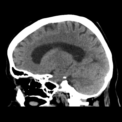 Cerebral metastasis to basal ganglia (Radiopaedia 81568-95412 E 38).png